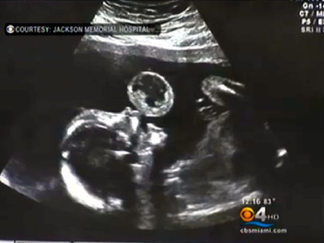 leyna gonzalez, jackson memorial hospital, oral teratoma 