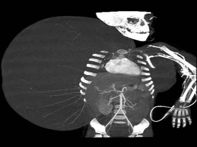 33 pound tumor, mexico city, x-ray 