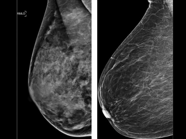 mammogram, breast density 