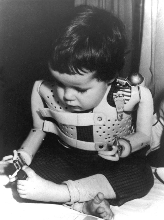 A 3-year-old girl, born without arms to a German mother who took the drug thalidomide, uses power-driven artificial arms in 1965. 
