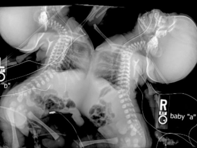 conjoined13.jpg 