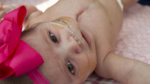 Baby born with heart outside body 