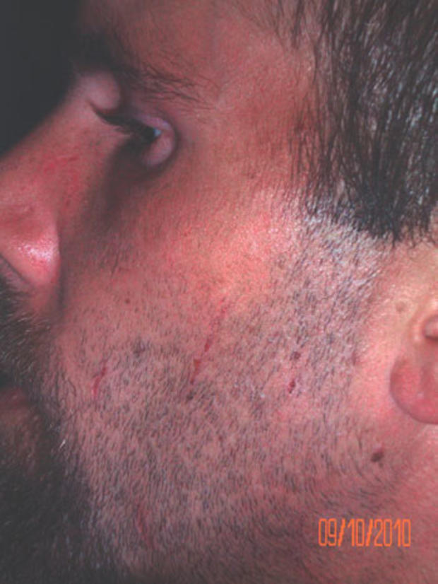 Scratches on Brian Pennington's face 