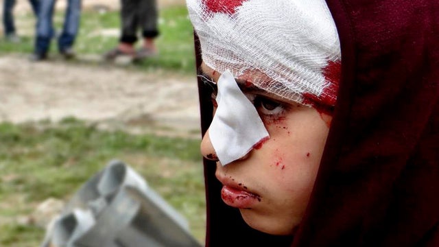 A Syrian child, injured by heavy bombing from military warplanes, is seen in the town of Hanano in Aleppo, Syria, March 1, 2013, in this citizen journalism image provided by Aleppo Media Center AMC, which has been authenticated based on its contents and o 