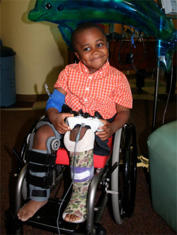 Robby has had more than 70 broken bones and 13 surgeries. He has steel rods in both legs. 