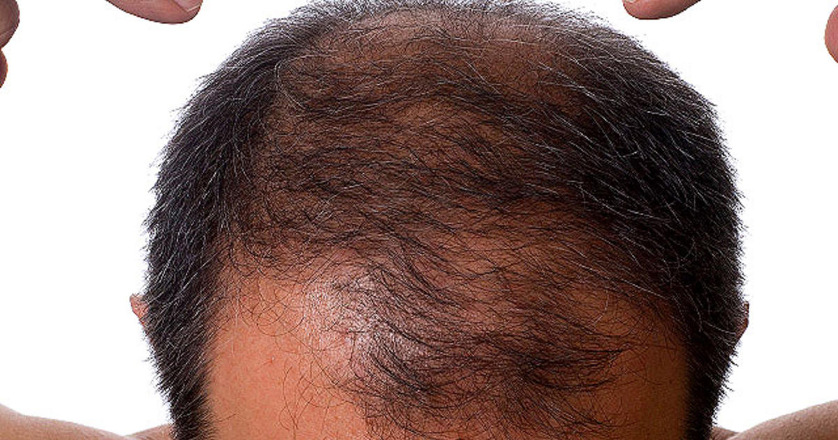 First-of-its-kind hair restoration method may grow follicles on bald spots  - CBS News