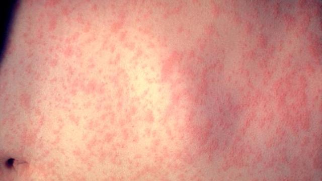 measles.jpg 
