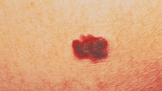 skin-cancer-1316406-getty-images.jpg 
