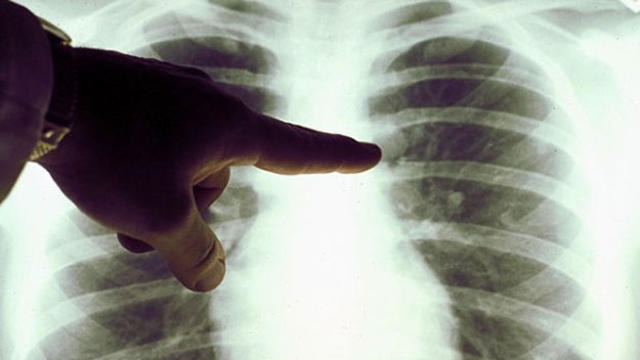 lung-cancer.jpg 