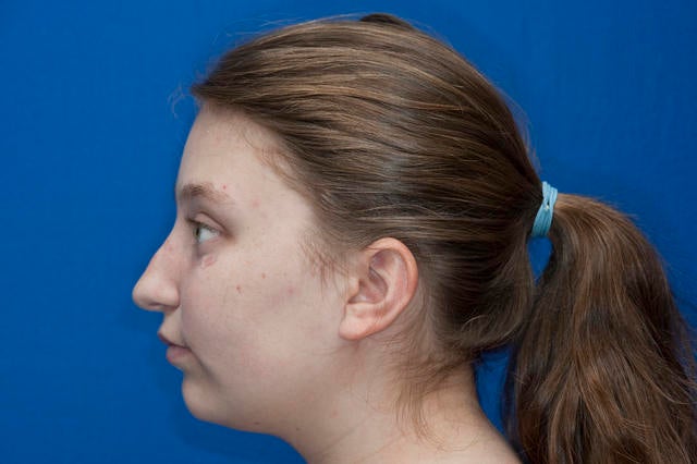 Natalie profile after Halo Device.jpg 