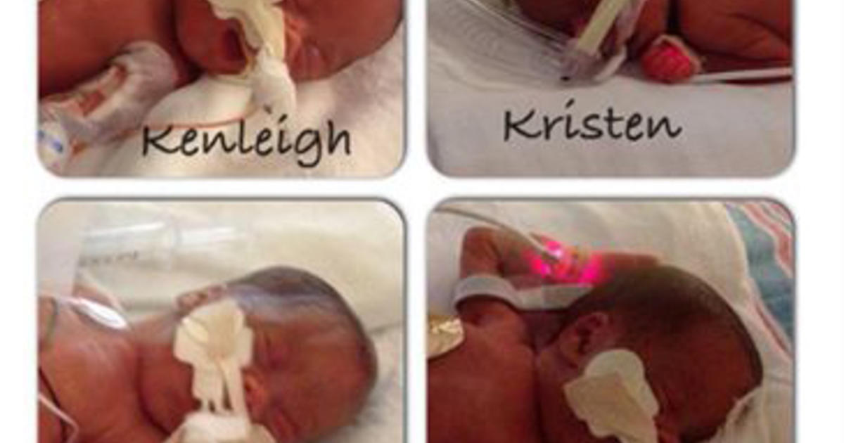 Surprise Mom Delivering Triplets Learns Shes Having Quadruplets Cbs News 