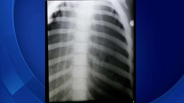 Pilgrim-Lung-x-ray 