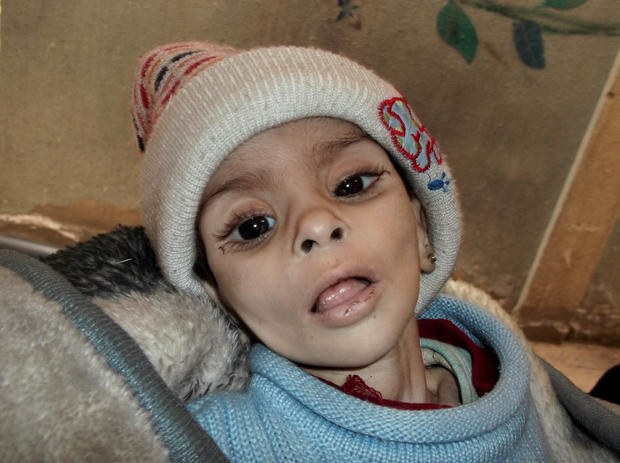 Palestinian refugee in Yarmouk camp who later died of hunger 