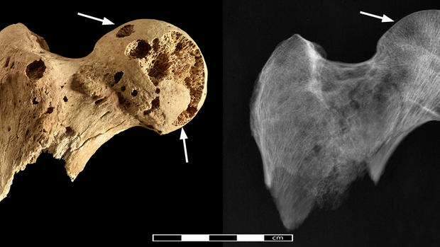 3,000-year-old skeleton riddled with cancer 