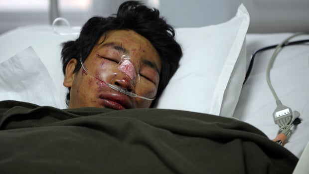 Nepalese mountaineer Dawa Tashi Sherpa, survivor of an avalanche on Mount Everest, lies in the Intensive Care Unit at Grandi International Hospital in Katmandu, Nepal, April 18, 2014. 