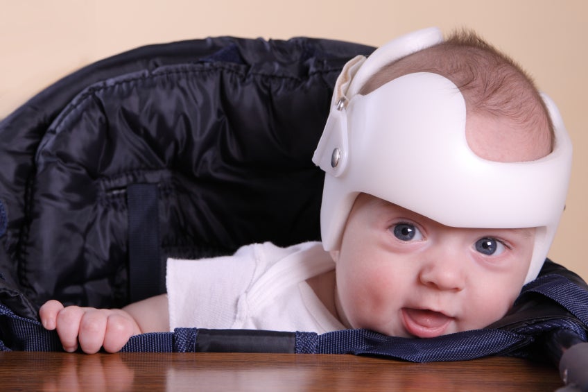 Helmets Not Helpful For Babies With flat Head Syndrome Study Finds CBS News
