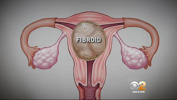 Fibroid 