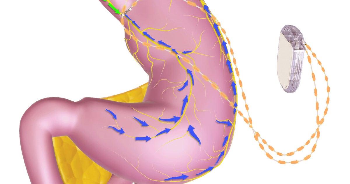 FDA panel to consider new weight-loss device - CBS News