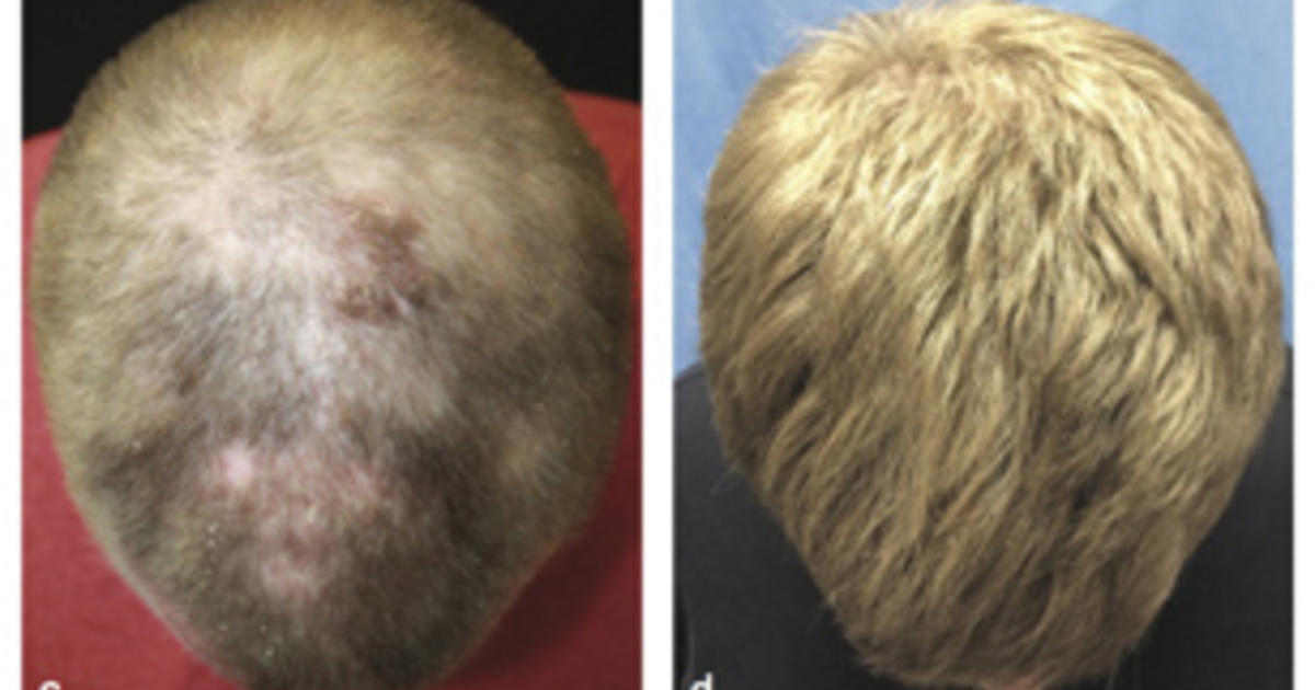 Arthritis drug helps hairless man regrow full head of hair - CBS News