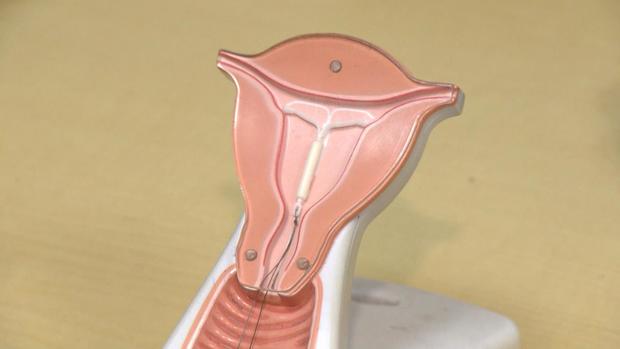 IUD intrauterine device 