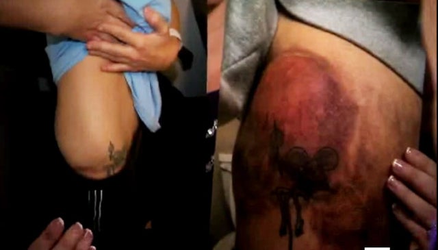 The photo on the left shows an area of Tracey Grissom's body that investigators took on Nov. 23, the night of the alleged rape. The photo on he right was taken by Tracey of the same area, just days after the alleged attack. 