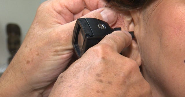 New guidelines for treating tinnitus, or ringing in the ears - CBS News