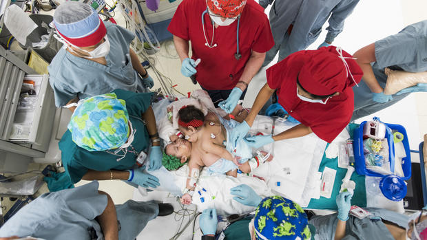 Conjoined twins successfully separated 