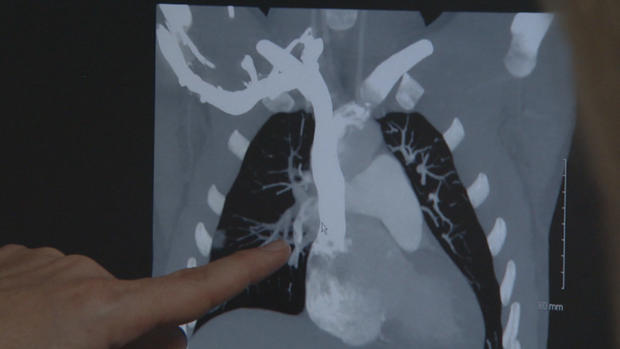 pulmonary embolism 
