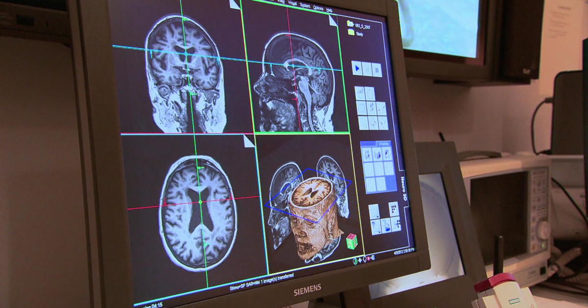 New trial to treat Alzheimer's seen as 