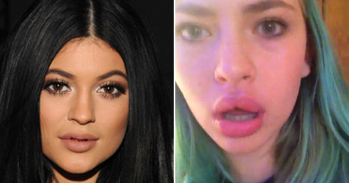 Kylie Jenner Lip Challenge Aftermath
