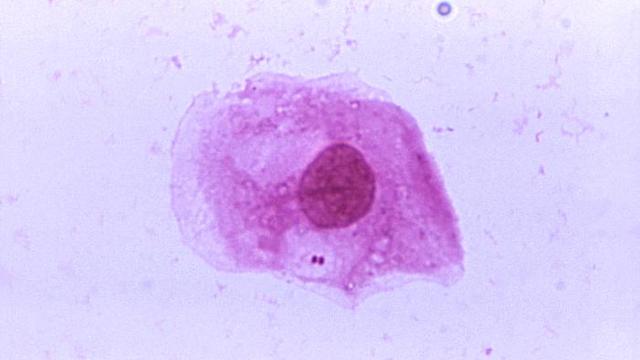 neisseria-meningitidis-meningococcal-meningitis.jpg 