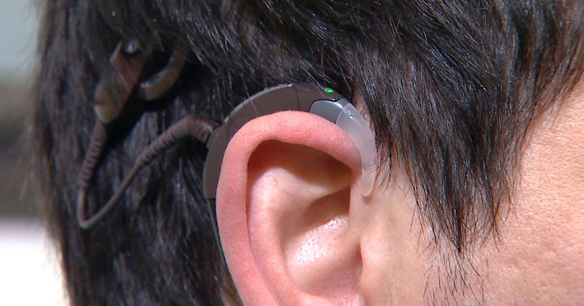 New Cochlear Implant Technology Gives Deaf People A 'New Ear' CBS