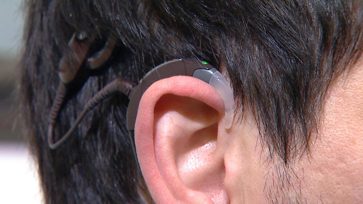 New Cochlear Implant Technology Gives Deaf People A 'New Ear' CBS