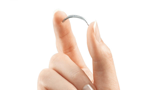 essure.jpg 