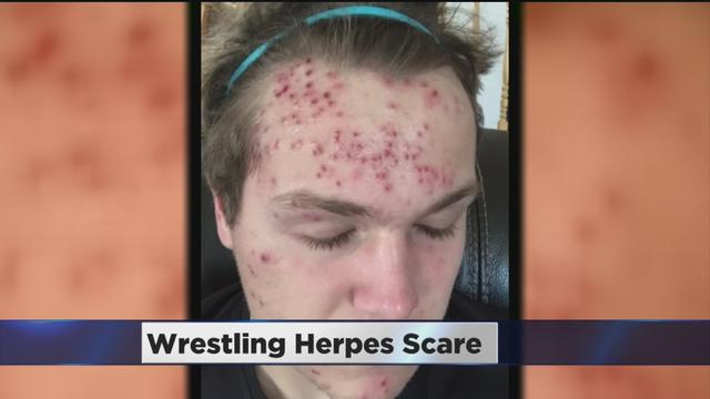 wrestling-herpes.jpg 