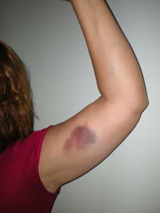 Jane Laut bruise on arm 