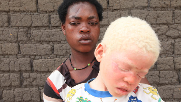 New limbs, new hope for Africa's hunted albino children 