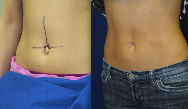 Belly buttons The tiny little body part people want plastic