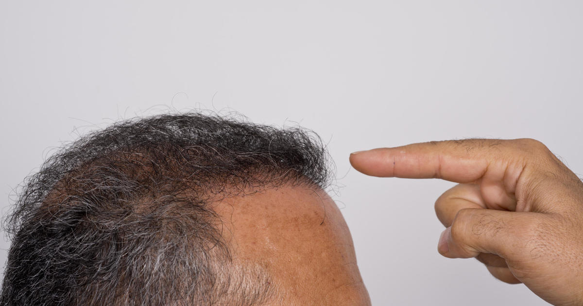 What people really think of men with hair transplants - CBS News