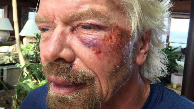 Sir Richard Branson is seen in an undated handout image issued by Virgin.com on Aug. 26, 2016, after he was involved in an accident when he crashed his bicycle on Virgin Gorda, one of the British Virgin Islands in the Caribbean. 