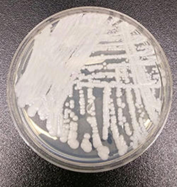 fungal-infection-2016-11-4.jpg 