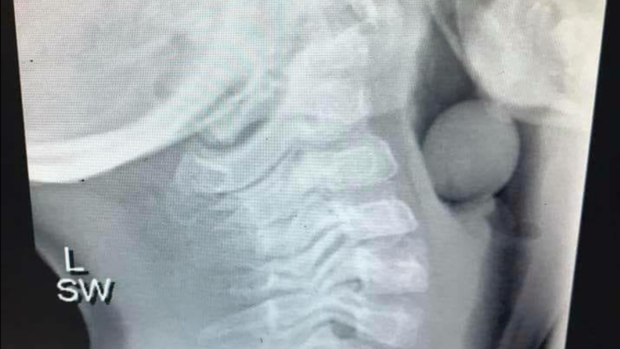 Shocking X-rays: Troubled teens' embedded objects 