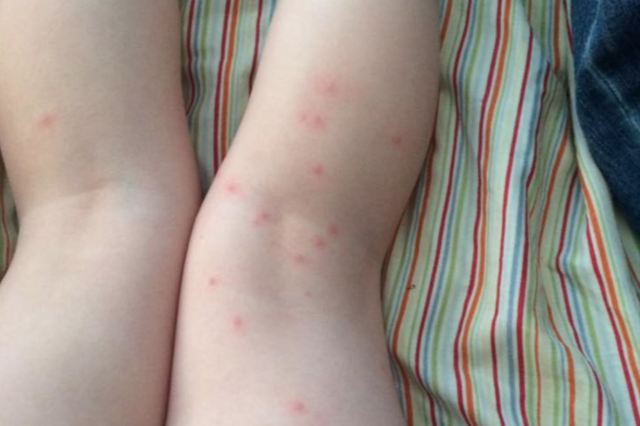 tick infestation human skin