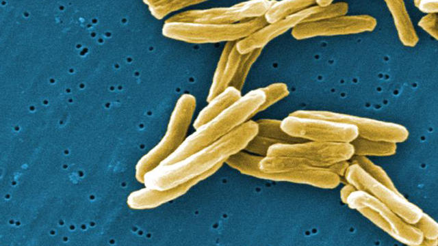 tuberculosis.jpg 
