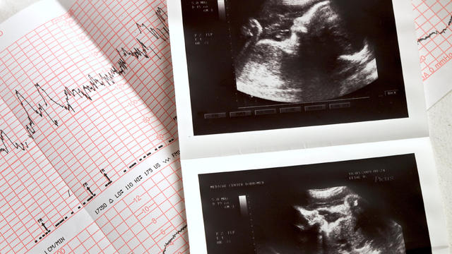 Ultrasound of fetus 