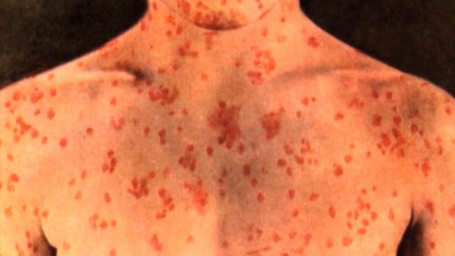 0118-health-measles-chicago-00-00-58-20-still001-1484596-640x360.jpg