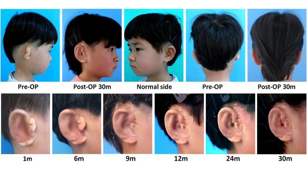 Scientists Grow New Ears 