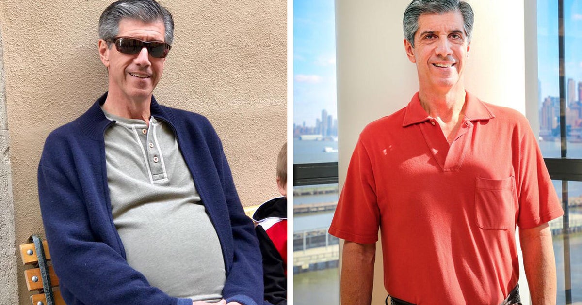 Man's "beer belly" turned out to be a 30pound tumor CBS News