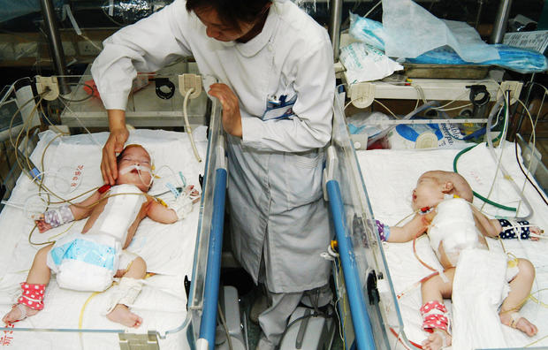 Siamese Twins Successfully Separated By Surgery 