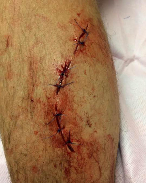 shark attack stitches 